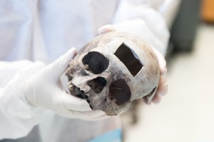 Portion of bone removed from a skull at UNT Health Science for DNA testing. Image courtesy UNT Health Science Center. 